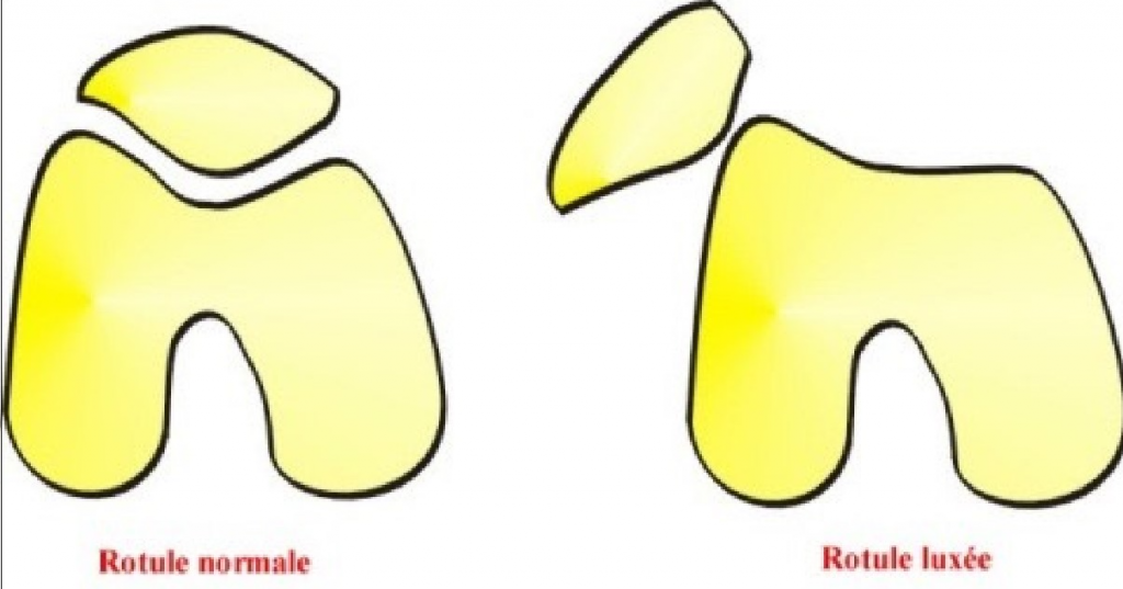 2 schéma luxation